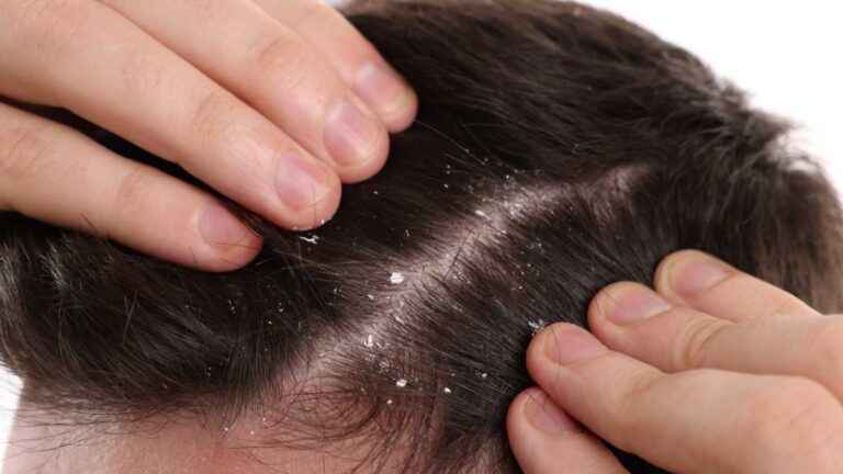 Produtos para queda de cabelo dão caspa