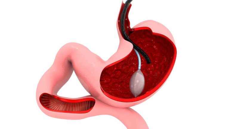 Quem pode fazer cirurgia bariátrica